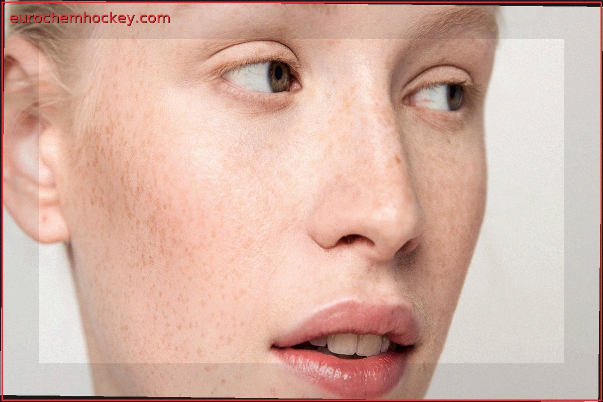 Azelaic Acid: A Versatile Solution for Acne, Redness, and Hyperpigmentation